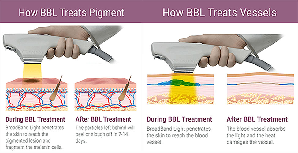 Why You Need to Try a BBL Treatment Ready Set Beauty