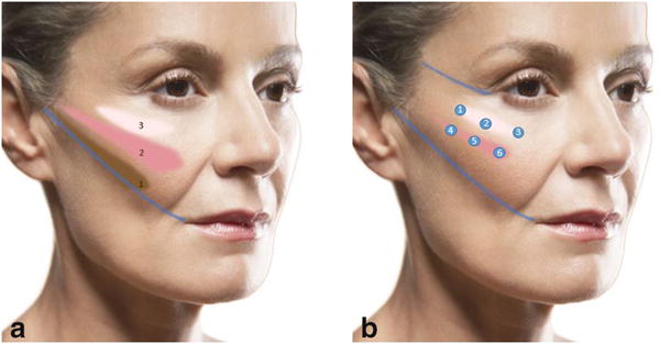 cheek lift with fillers